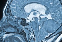 Hypnose bei Gehirnoperationen: Eine sicherere Methode