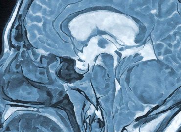 Hypnose bei Gehirnoperationen: Eine sicherere Methode