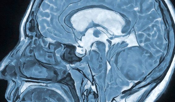 Hypnose bei Gehirnoperationen: Eine sicherere Methode