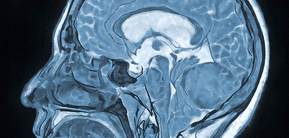 Hypnose bei Gehirnoperationen: Eine sicherere Methode