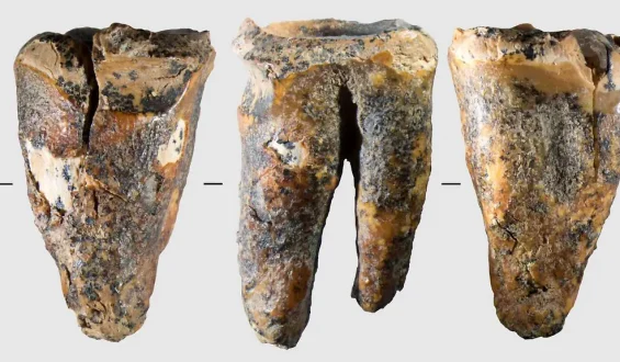 Neandertaler kannten bereits Zahnärzte