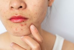 Akne: Ursachen, Folgen und nachhaltige Behandlungsmöglichkeiten