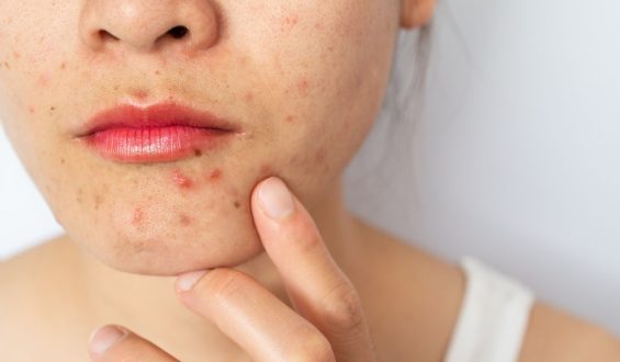 Akne: Ursachen, Folgen und nachhaltige Behandlungsmöglichkeiten