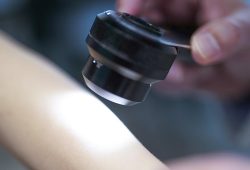 Studie untersucht mRNA-Impfung gegen Hautkrebs