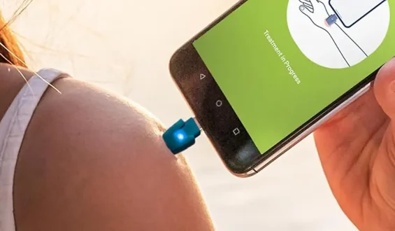 Hilfe gegen Juckreiz: Insektenstichheiler am Prime Day günstig